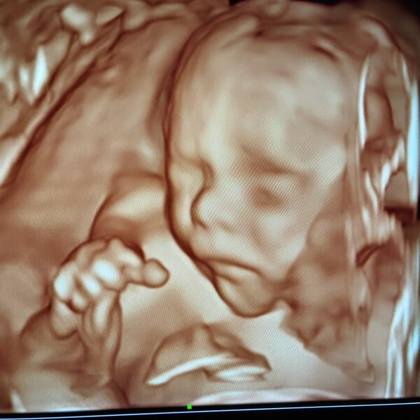 3D Ultrasound